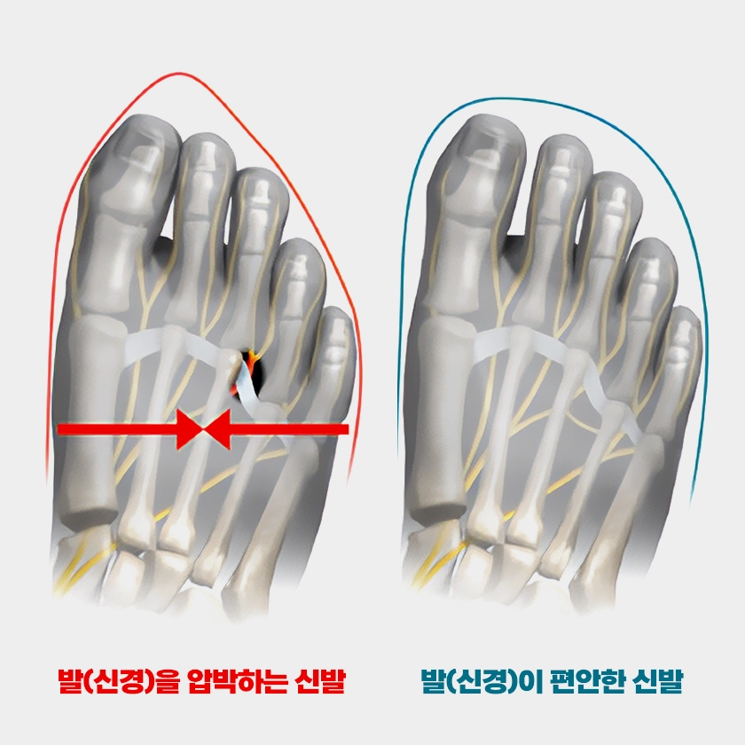 집에서 할 수 있는 지간신경종 치료