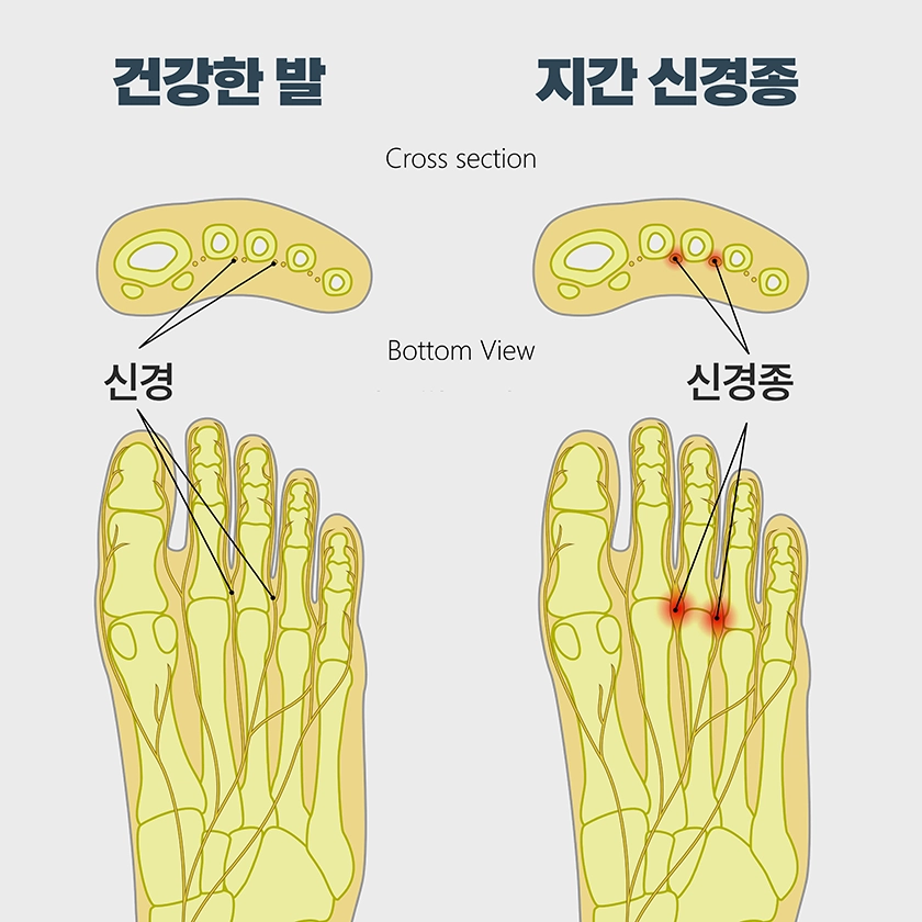 지간신경종의 증상과 원인